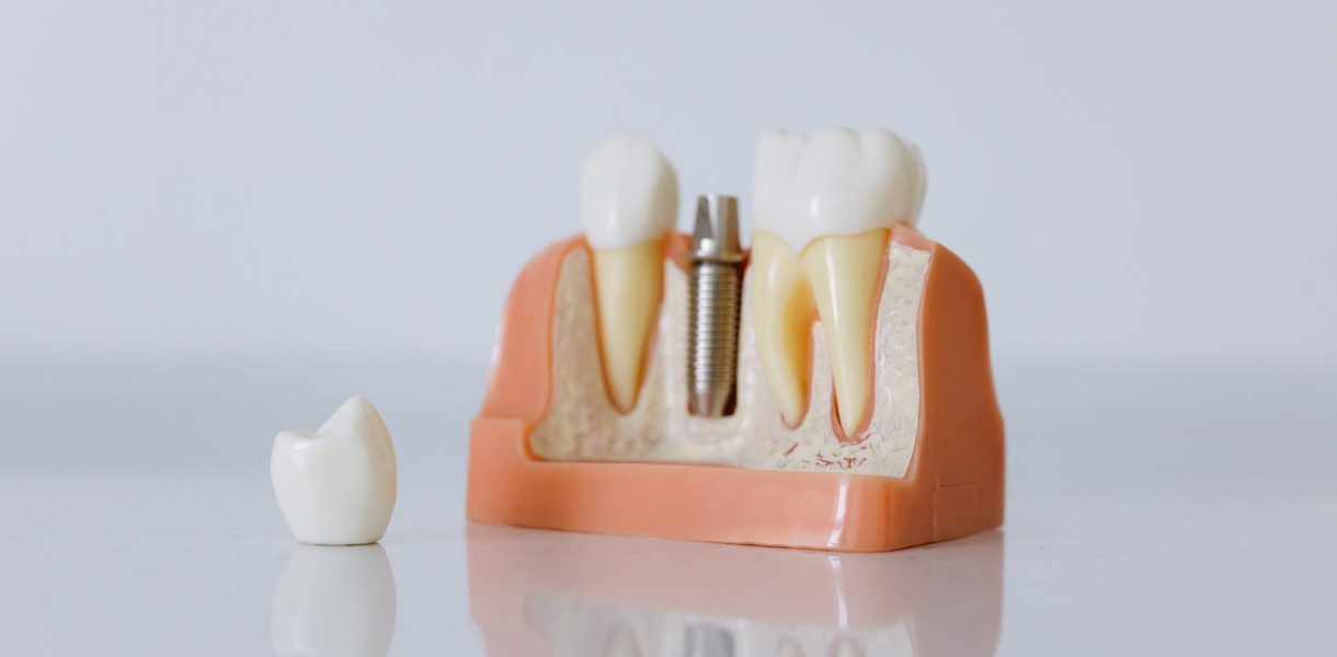 So gut sind moderne Zahnimplantate wirklich