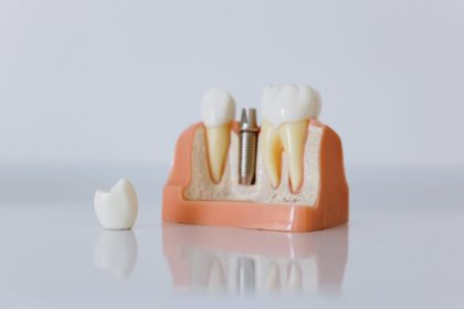 So gut sind moderne Zahnimplantate wirklich